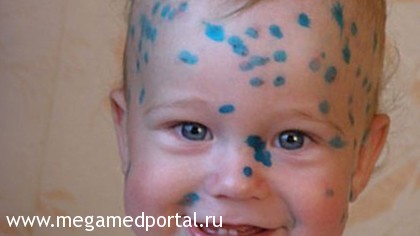 Импетиго у ребёнка – симптомы, признаки, лечение Импетиго у ребёнка – симптомы, признаки, лечение