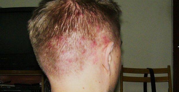 Прыщи на голове: причины появления, методы лечения Прыщи на голове: причины появления, методы лечения