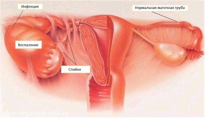 Аднексит: диагностика и лечение Аднексит
