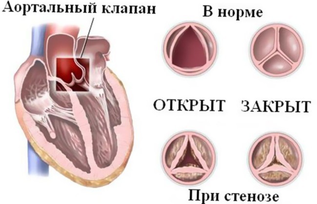 Аортальный стеноз