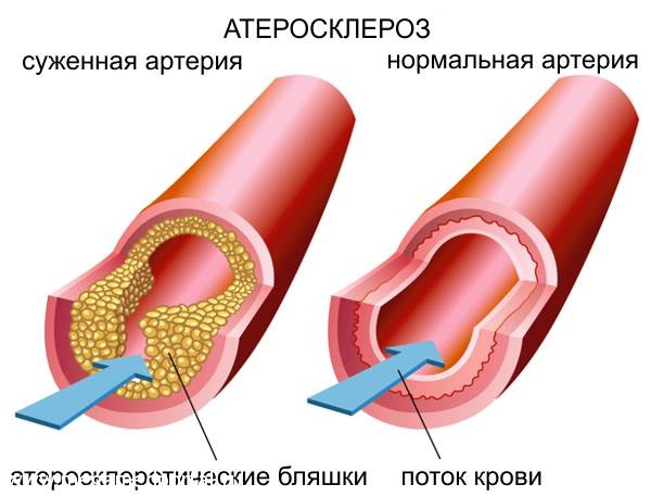 Атеросклероз