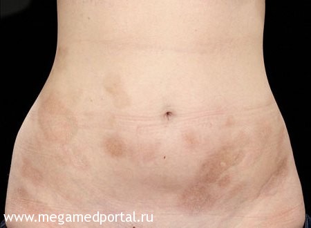 Бляшечная склеродермия
