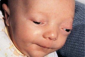 Чем опасно внутричерепное давление