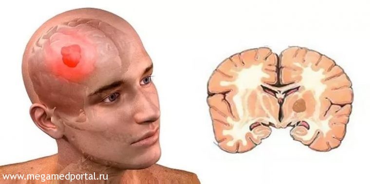 Лечение глиобластомы за границей глиобластома