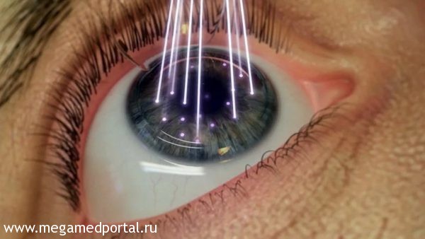 лазерная коррекция зрения показания