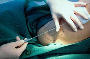 Последствия липосакции Последствия липосакции