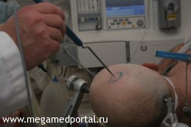 Операция на гипофиз