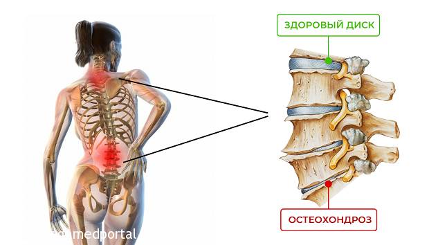 Когда жизнь боль: как помочь себе при остеохондрозе остеохондроз