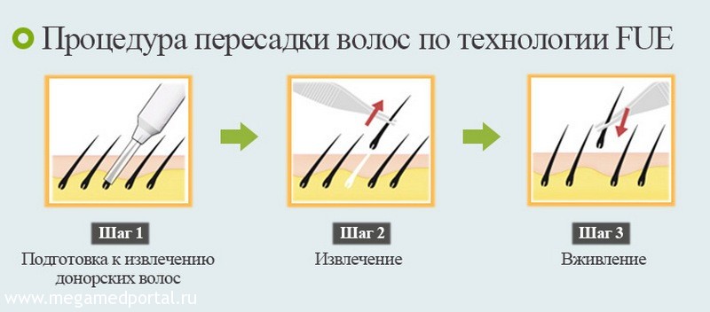 пересадка волос