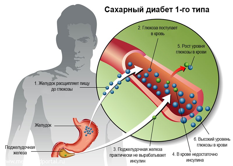 Сахарный диабет 1 типа