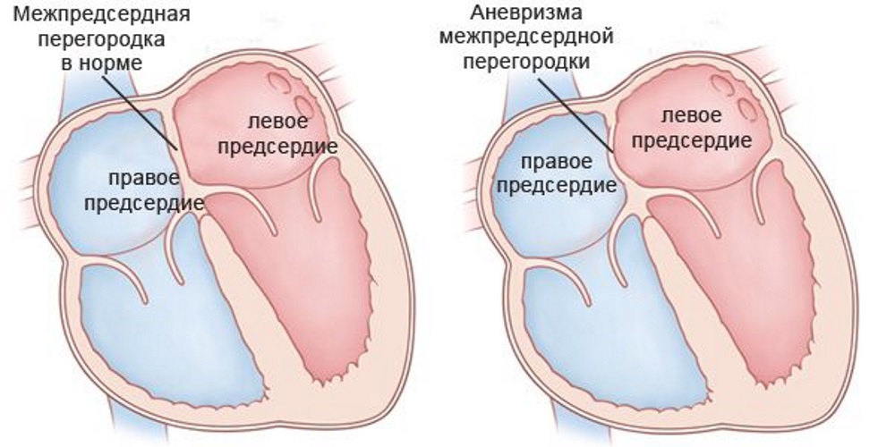 anevrisma-mpp