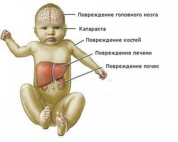 опасность галактоземии