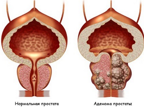 фото здоровой и больной предстательной железы