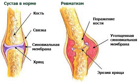 признаки ревматизма